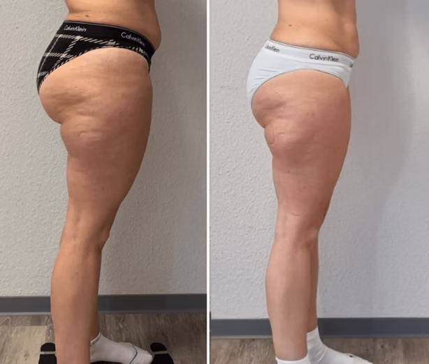 Nur 10 Behandlungen/-12kg